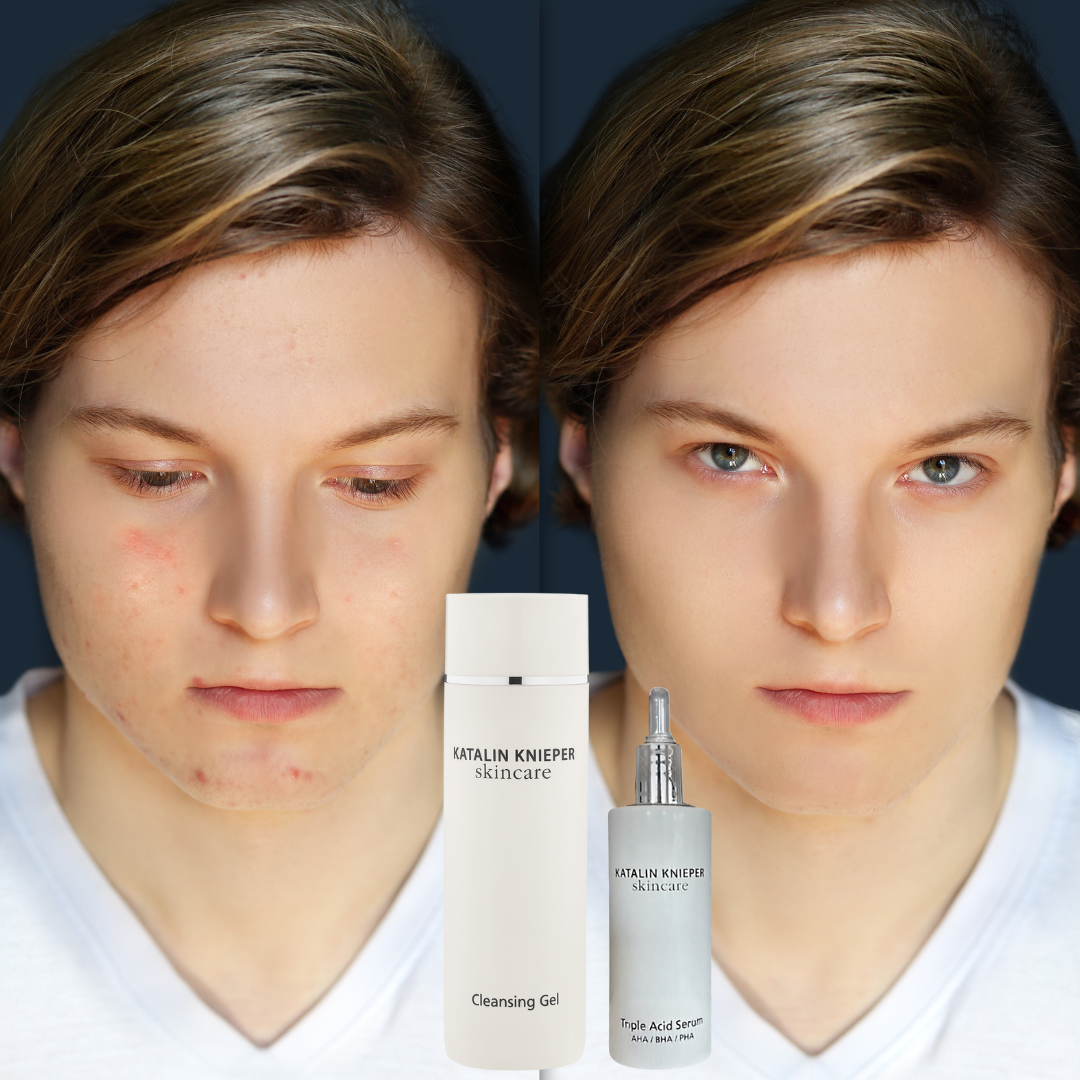 Basis Reinigungs- und Pflegeroutine für unreine Haut