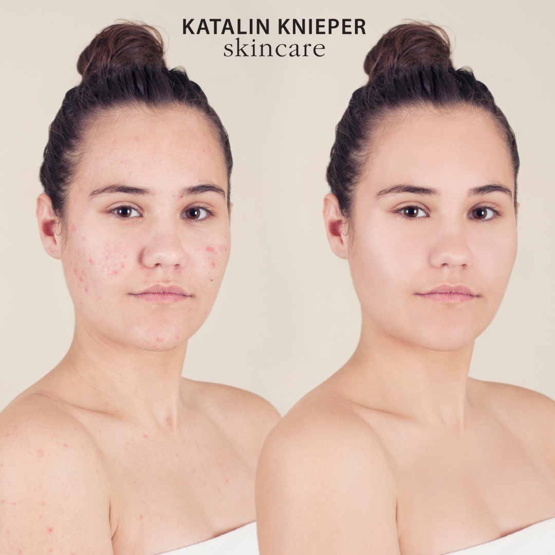 Basis Reinigungs- und Pflegeroutine für unreine Haut